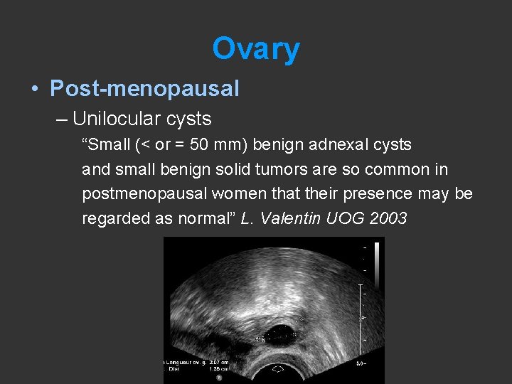 Ovary • Post-menopausal – Unilocular cysts “Small (< or = 50 mm) benign adnexal