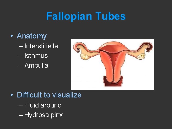 Fallopian Tubes • Anatomy – Interstitielle – Isthmus – Ampulla • Difficult to visualize