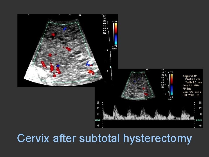 Cervix after subtotal hysterectomy 