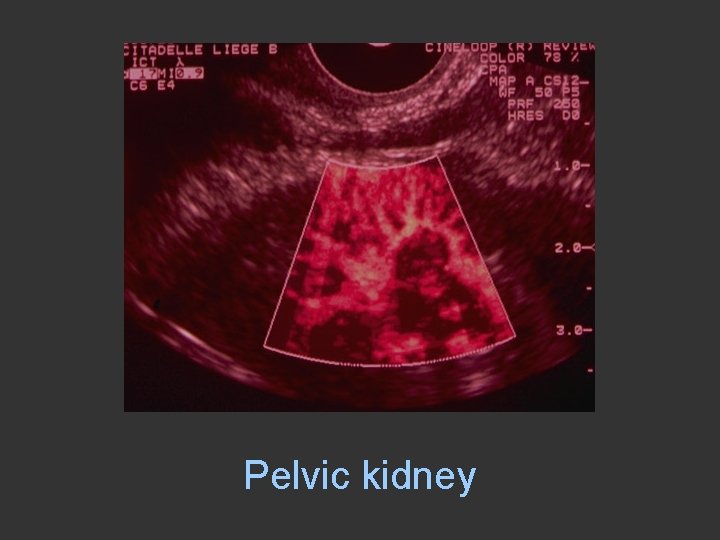 Pelvic kidney 