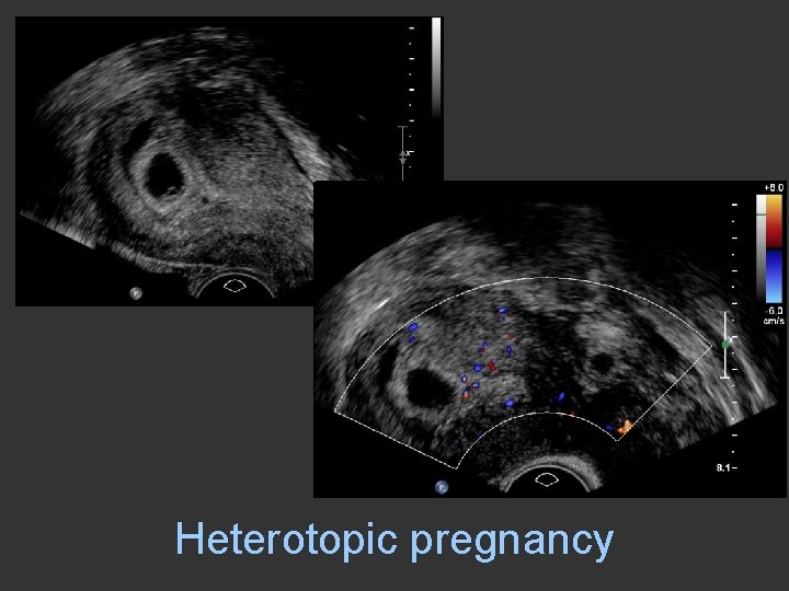 Heterotopic pregnancy 