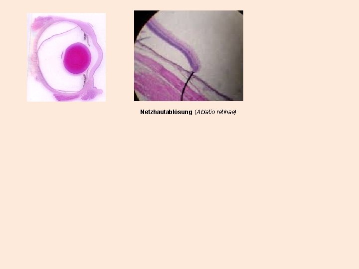 Netzhautablösung (Ablatio retinae) 