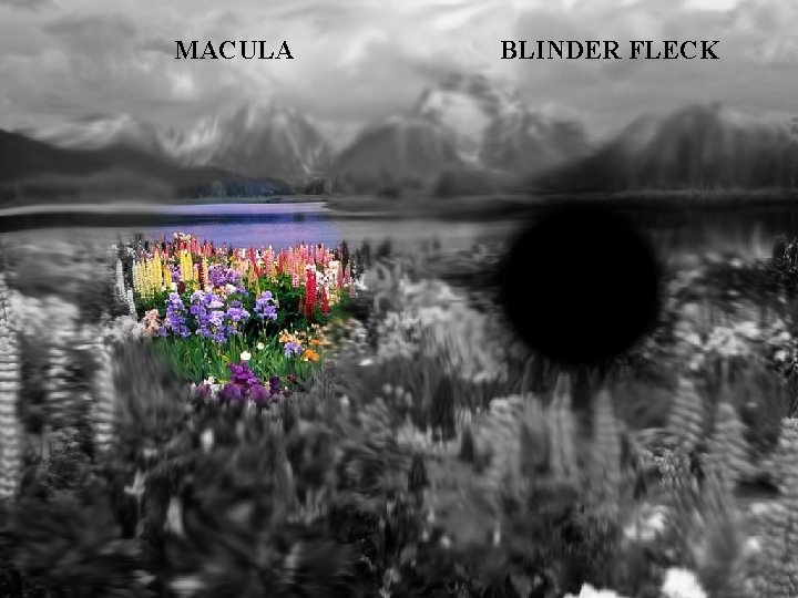 MACULA BLINDER FLECK 