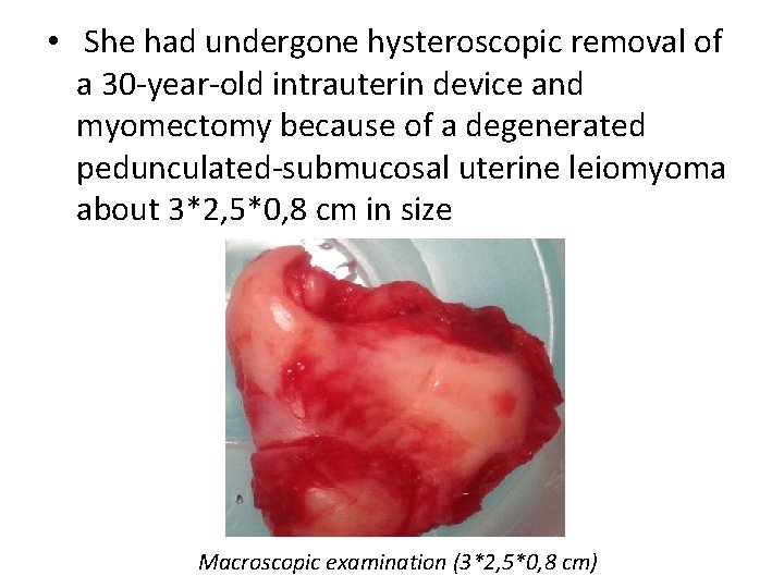 • She had undergone hysteroscopic removal of a 30 year old intrauterin device