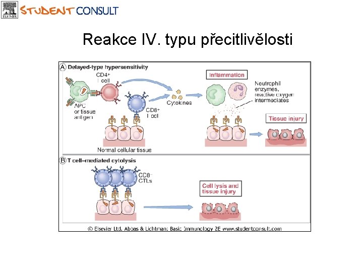 Reakce IV. typu přecitlivělosti 