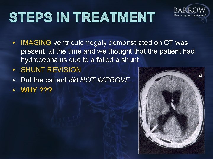 STEPS IN TREATMENT • IMAGING ventriculomegaly demonstrated on CT was present at the time