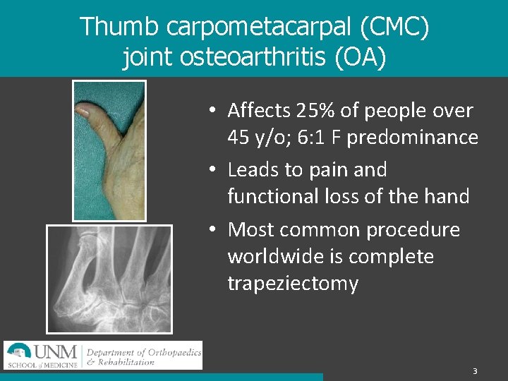 Thumb carpometacarpal (CMC) joint osteoarthritis (OA) • Affects 25% of people over 45 y/o;