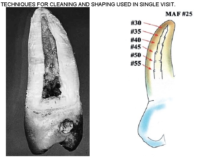 TECHNIQUES FOR CLEANING AND SHAPING USED IN SINGLE VISIT. 