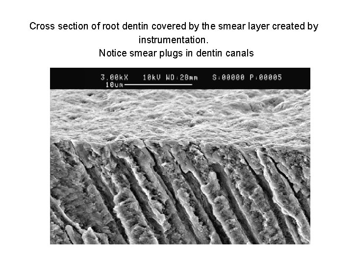 Cross section of root dentin covered by the smear layer created by instrumentation. Notice