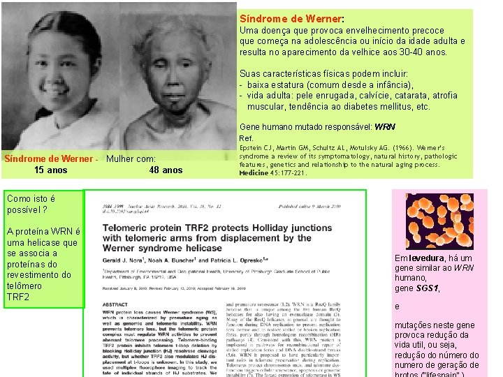 Síndrome de Werner: Uma doença que provoca envelhecimento precoce que começa na adolescência ou