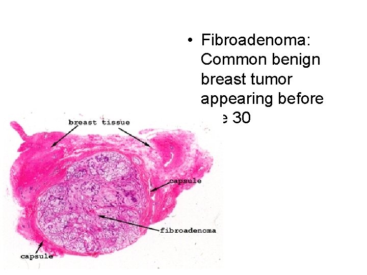  • Fibroadenoma: Common benign breast tumor appearing before age 30 