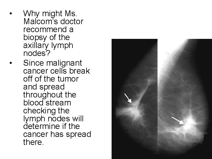  • • Why might Ms. Malcom’s doctor recommend a biopsy of the axillary