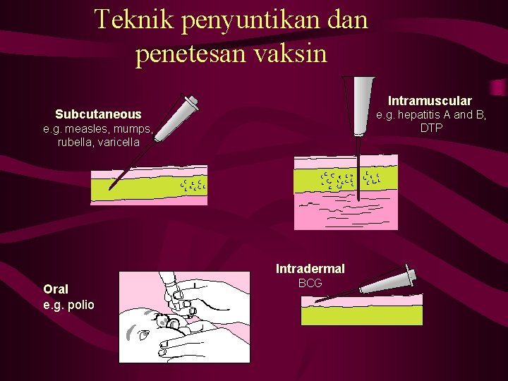 Teknik penyuntikan dan penetesan vaksin Intramuscular Subcutaneous e. g. hepatitis A and B, DTP