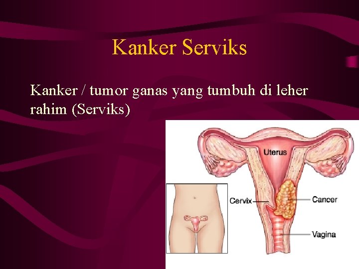 Kanker Serviks Kanker / tumor ganas yang tumbuh di leher rahim (Serviks) 