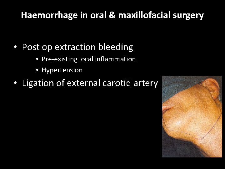 Haemorrhage in oral & maxillofacial surgery • Post op extraction bleeding • Pre-existing local Haemorrhage in oral & maxillofacial surgery • Post op extraction bleeding • Pre-existing local