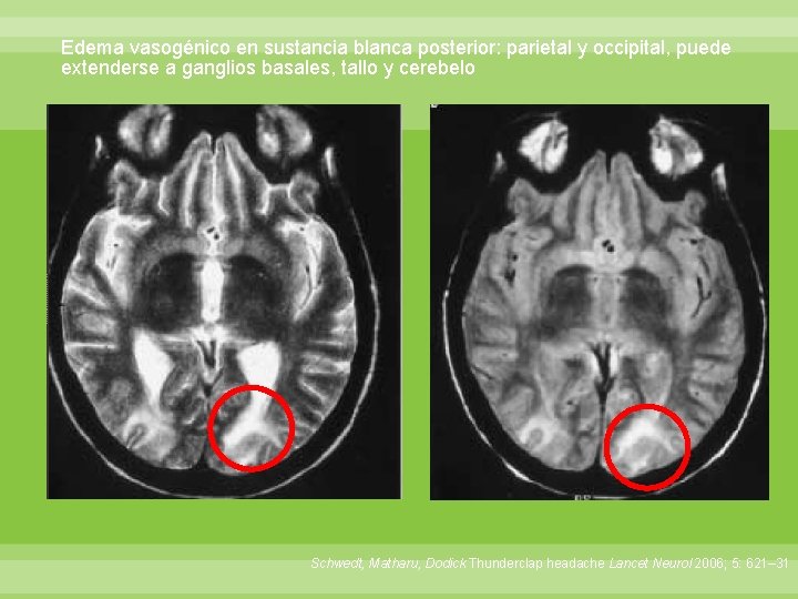 Edema vasogénico en sustancia blanca posterior: parietal y occipital, puede extenderse a ganglios basales,