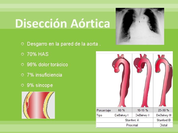 Disección Aórtica Desgarro en la pared de la aorta. 70% HAS 96% dolor torácico