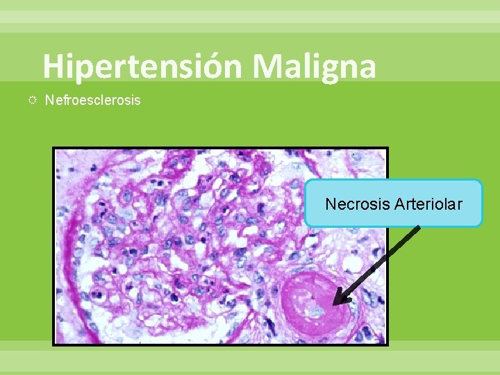 Hipertensión Maligna Nefroesclerosis Necrosis Arteriolar 