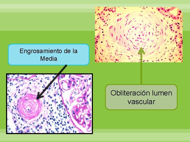 Engrosamiento de la Media Obliteración lumen vascular 