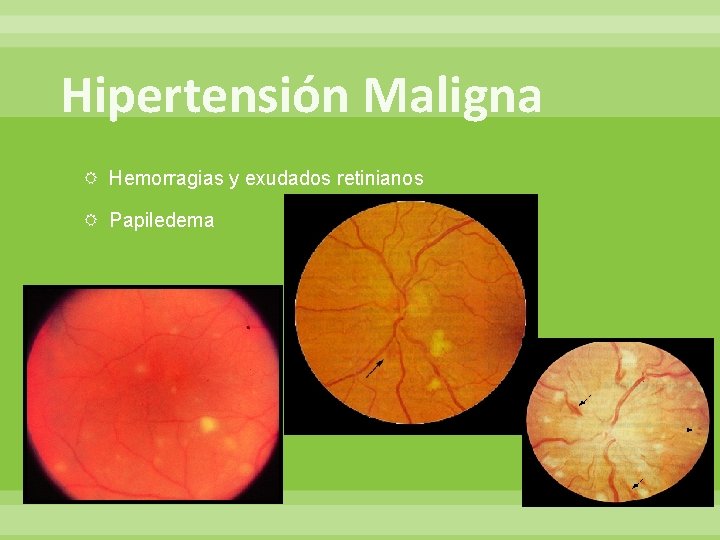 Hipertensión Maligna Hemorragias y exudados retinianos Papiledema 