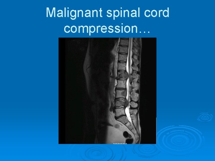 Malignant spinal cord compression… Malignant spinal cord compression…