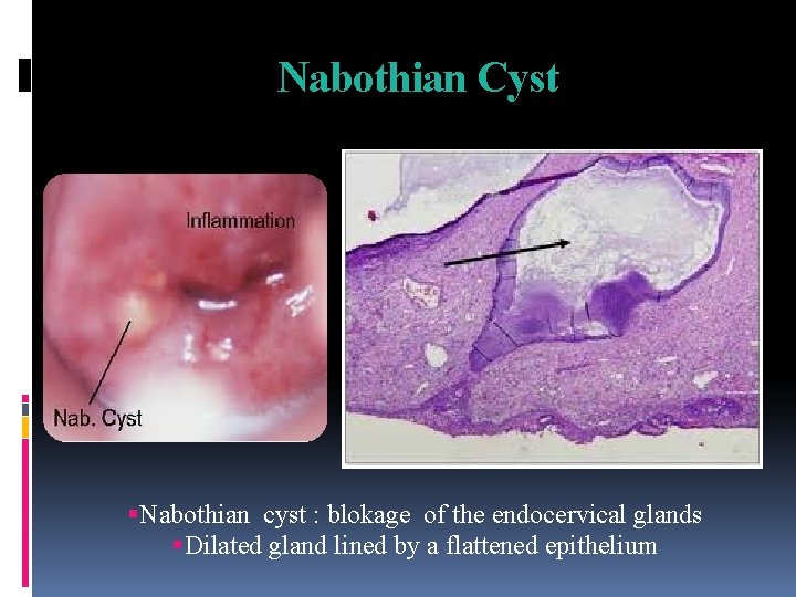 Nabothian Cyst Nabothian cyst : blokage of the endocervical glands Dilated gland lined by