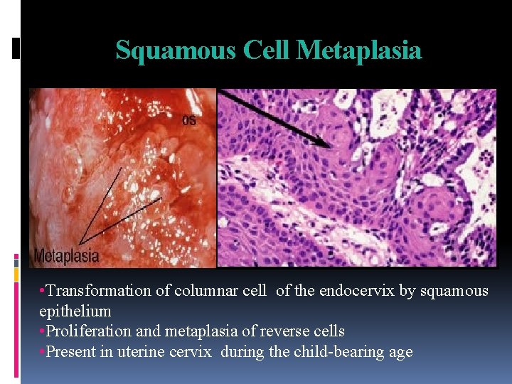 Squamous Cell Metaplasia • Transformation of columnar cell of the endocervix by squamous epithelium