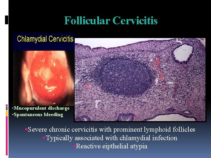 Follicular Cervicitis • Mucopurulent discharge • Spontaneous bleeding Severe chronic cervicitis with prominent lymphoid