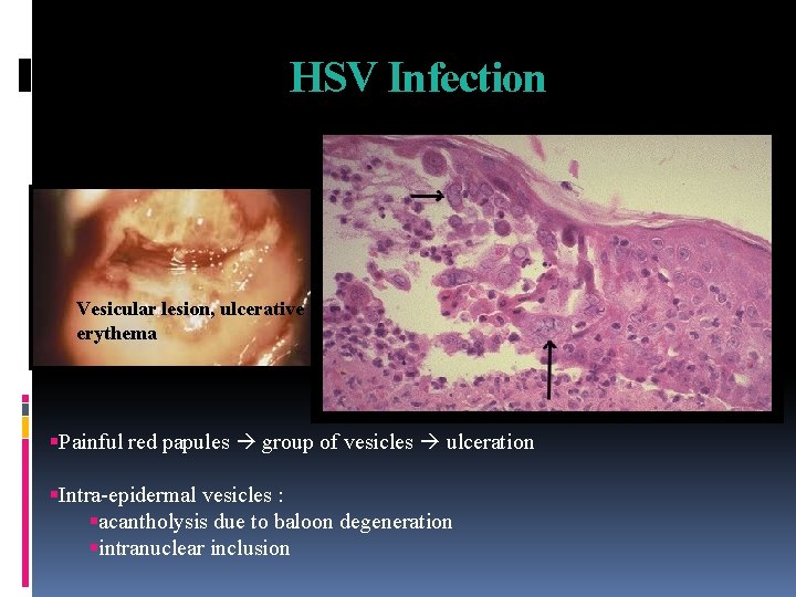 HSV Infection Vesicular lesion, ulcerative erythema Painful red papules group of vesicles ulceration Intra-epidermal