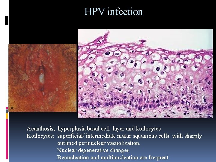 HPV infection Acanthosis, hyperplasia basal cell layer and koilocytes Koilocytes: superficial/ intermediate matur squamous