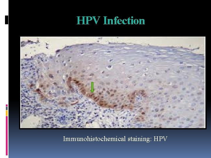 HPV Infection Immunohistochemical staining: HPV 