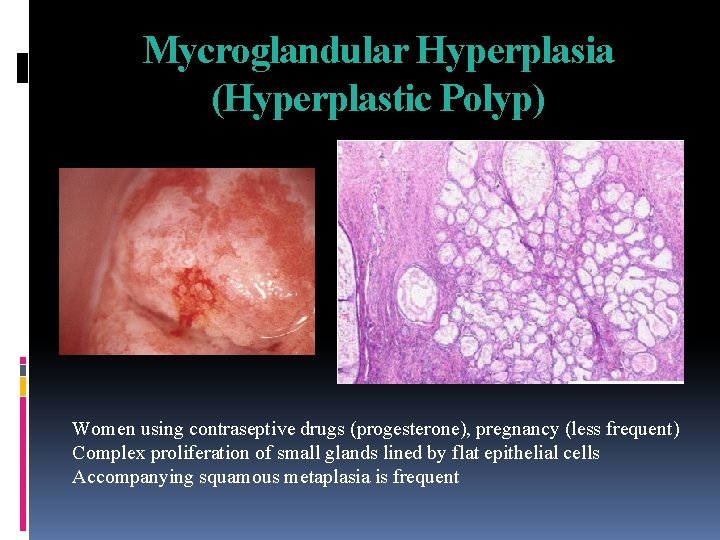 Mycroglandular Hyperplasia (Hyperplastic Polyp) Women using contraseptive drugs (progesterone), pregnancy (less frequent) Complex proliferation