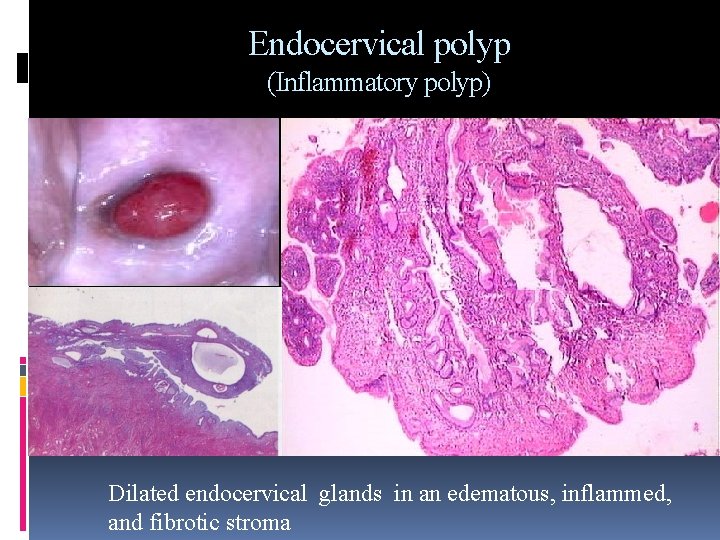 Endocervical polyp (Inflammatory polyp) Dilated endocervical glands in an edematous, inflammed, and fibrotic stroma