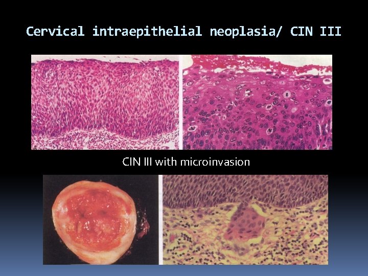 Cervical intraepithelial neoplasia/ CIN III with microinvasion 