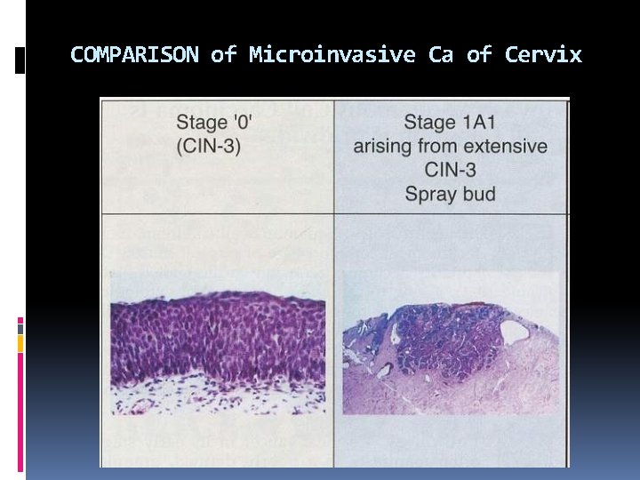 COMPARISON of Microinvasive Ca of Cervix 