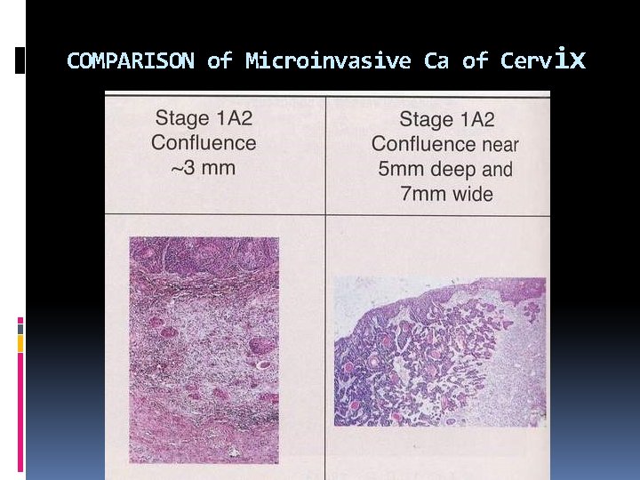 COMPARISON of Microinvasive Ca of Cervix 