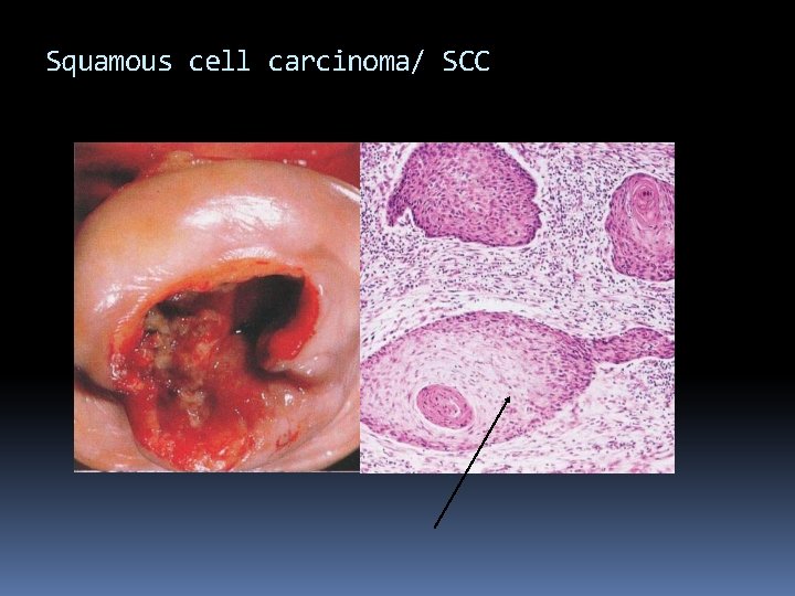 Squamous cell carcinoma/ SCC 