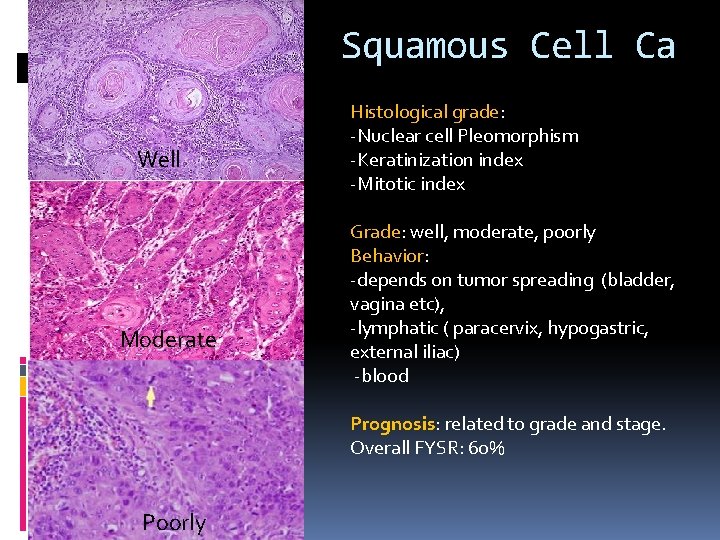 Squamous Cell Ca Well Moderate Histological grade: -Nuclear cell Pleomorphism -Keratinization index -Mitotic index