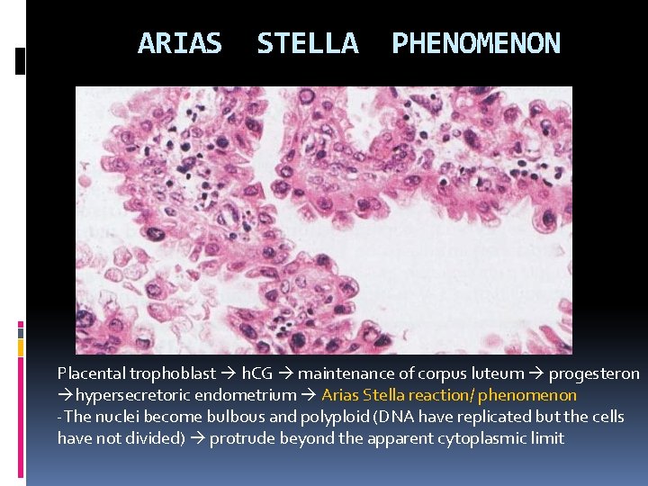 ARIAS STELLA PHENOMENON Placental trophoblast h. CG maintenance of corpus luteum progesteron hypersecretoric endometrium