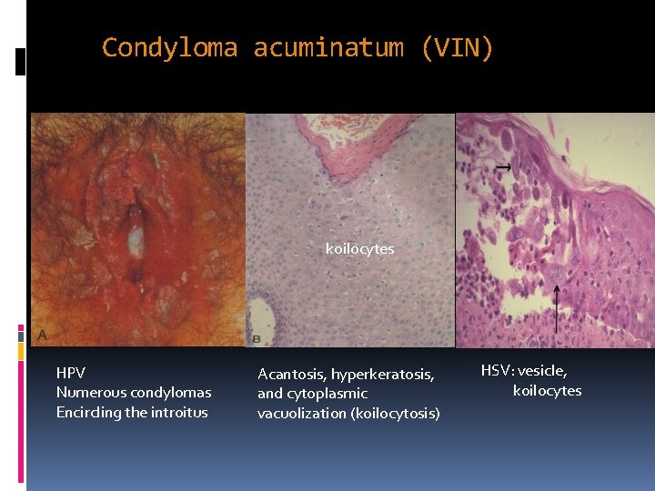 Condyloma acuminatum (VIN) koilocytes HPV Numerous condylomas Encircling the introitus Acantosis, hyperkeratosis, and cytoplasmic