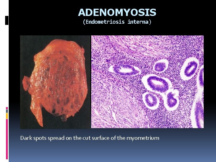 ADENOMYOSIS (Endometriosis interna) Endometrial tissue miometirum Dark spots spread on the cut surface of