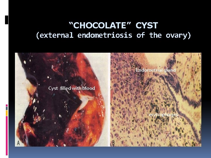 “CHOCOLATE” CYST (external endometriosis of the ovary) Endometrial gland Cyst filled with blood erytrophages