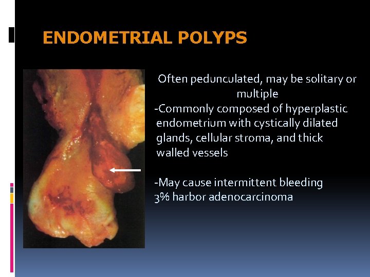 ENDOMETRIAL POLYPS Often pedunculated, may be solitary or multiple -Commonly composed of hyperplastic endometrium