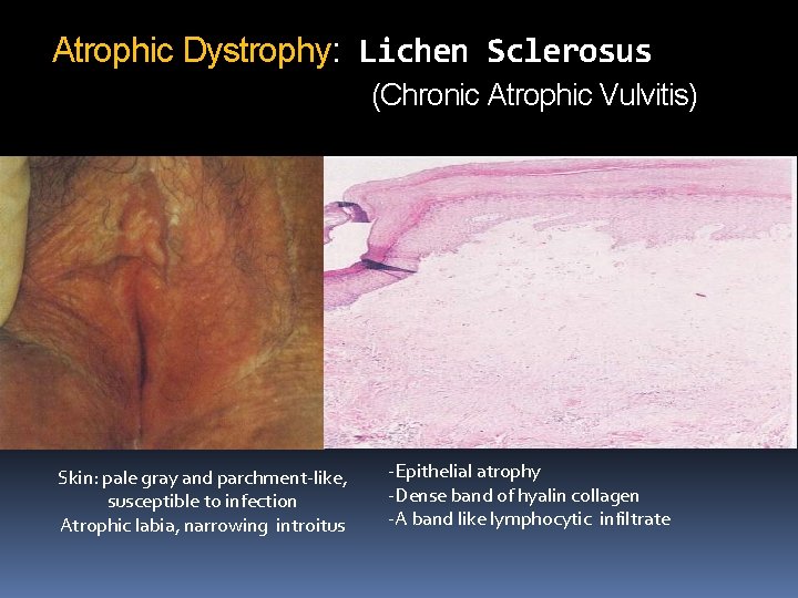 Atrophic Dystrophy: Lichen Sclerosus (Chronic Atrophic Vulvitis) Skin: pale gray and parchment-like, susceptible to