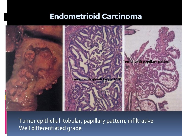 Endometrioid Carcinoma Tumor with papillary pattern Tumor with glandular pattern Tumor epithelial : tubular,