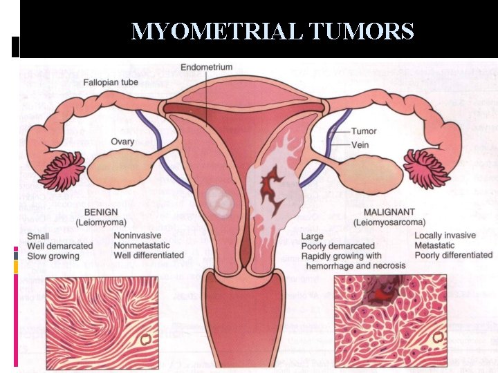MYOMETRIAL TUMORS 