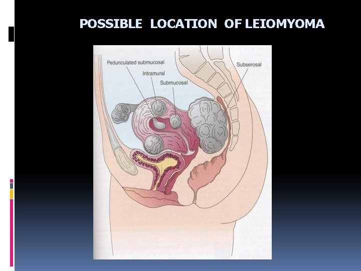 POSSIBLE LOCATION OF LEIOMYOMA 