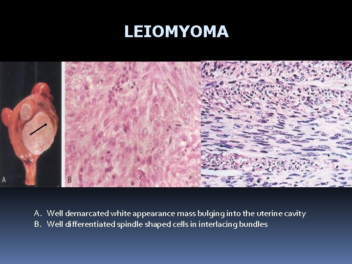 LEIOMYOMA A. Well demarcated white appearance mass bulging into the uterine cavity B. Well