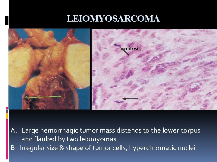 LEIOMYOSARCOMA mitosis A. Large hemorrhagic tumor mass distends to the lower corpus and flanked