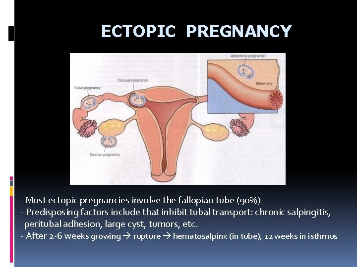 ECTOPIC PREGNANCY - Most ectopic pregnancies involve the fallopian tube (90%) - Predisposing factors